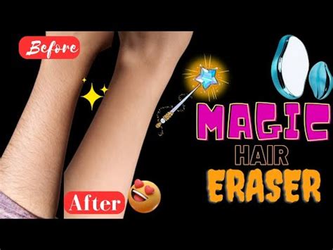 Get rid of unwanted hair for good with London's innovative magic hair remover
